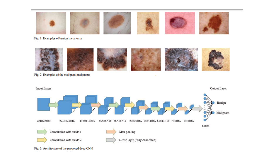 Deep Convolutional Neural Network for Melanoma Image Classification